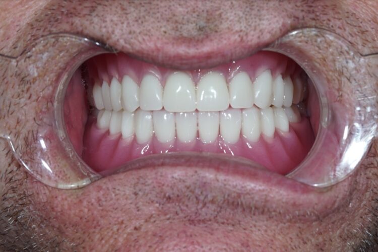 Акрилові зубні протези в Києві