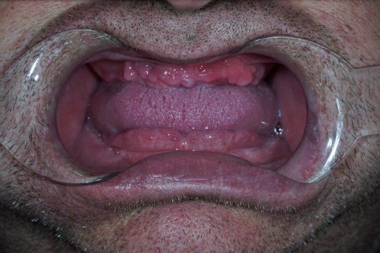 Акрилові зубні протези в Києві