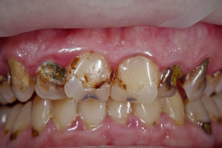 Керамические зубные коронки