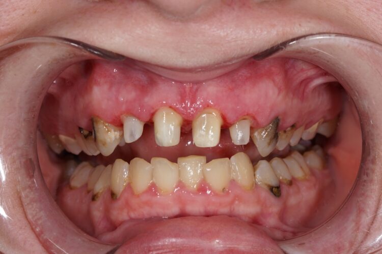 Керамические зубные коронки