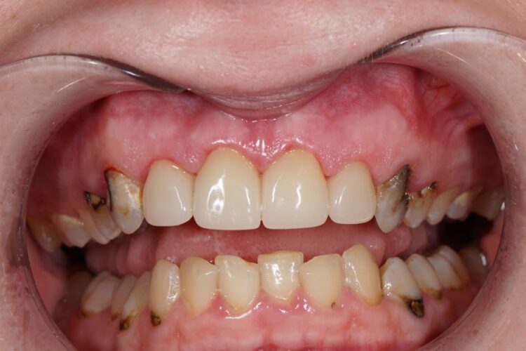 Керамические зубные коронки