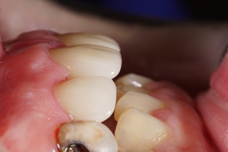 Керамические зубные коронки