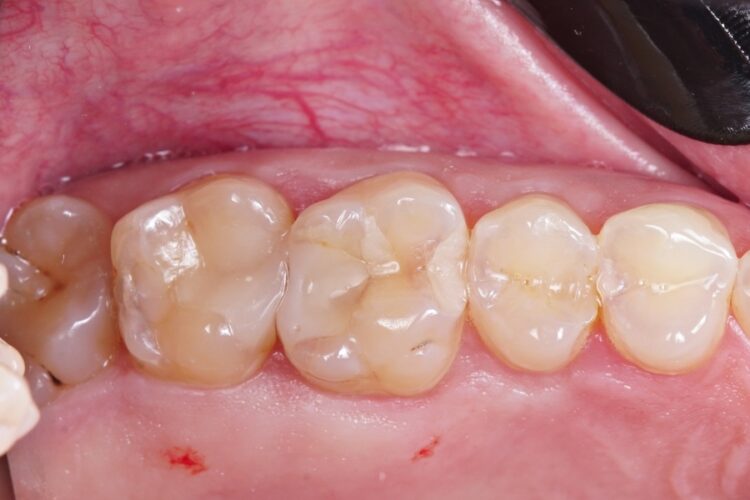 Пломбування зубів