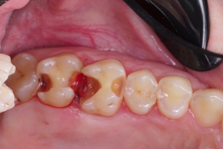 Пломбування зубів