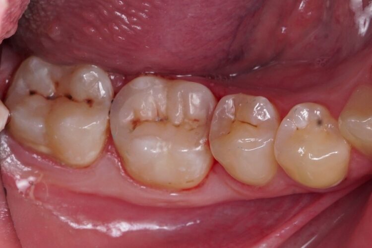 Пломбування зубів