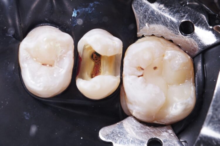 Реставрація зубів