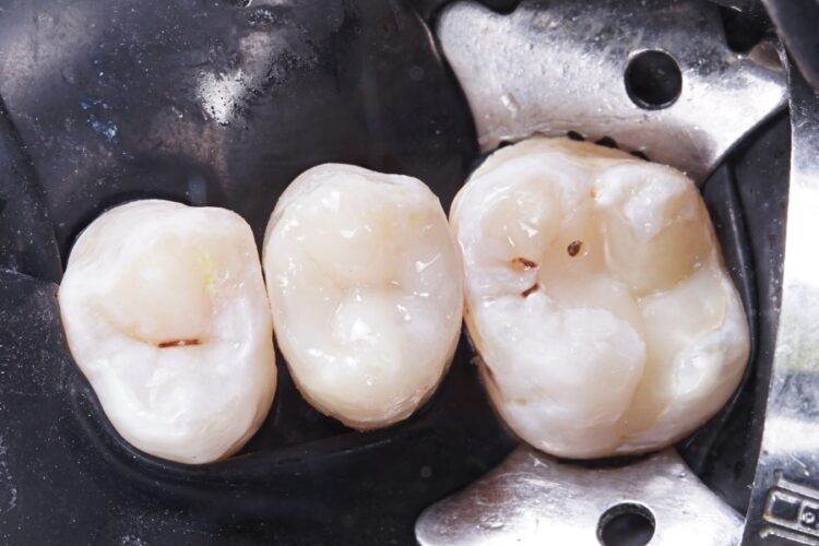 Реставрація зубів