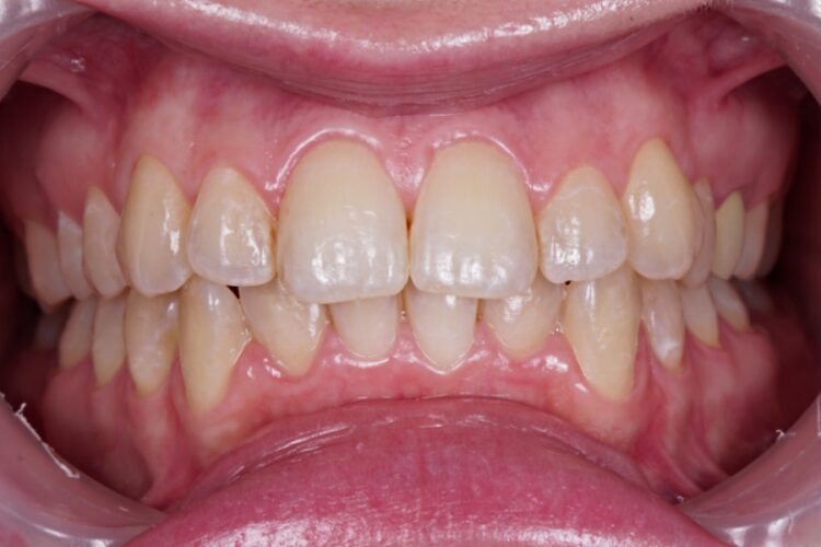 Відбілювання зубів