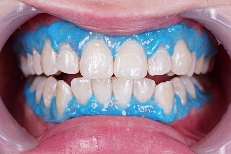 Відбілювання зубів