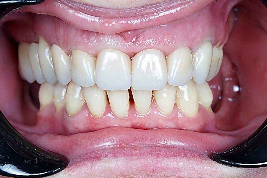 Замена металлокерамических коронок